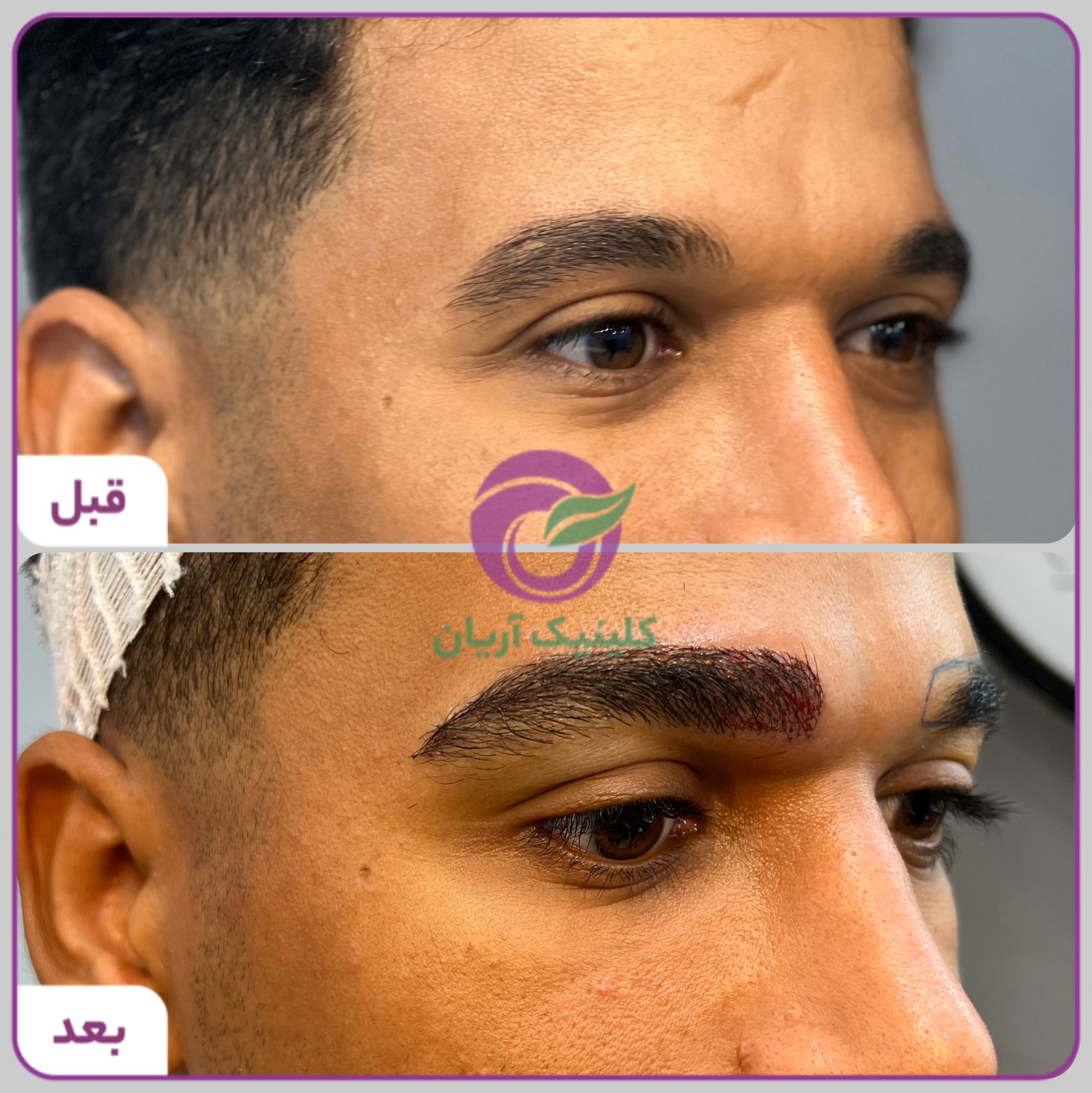 گالری فیلم کاشت ابرو